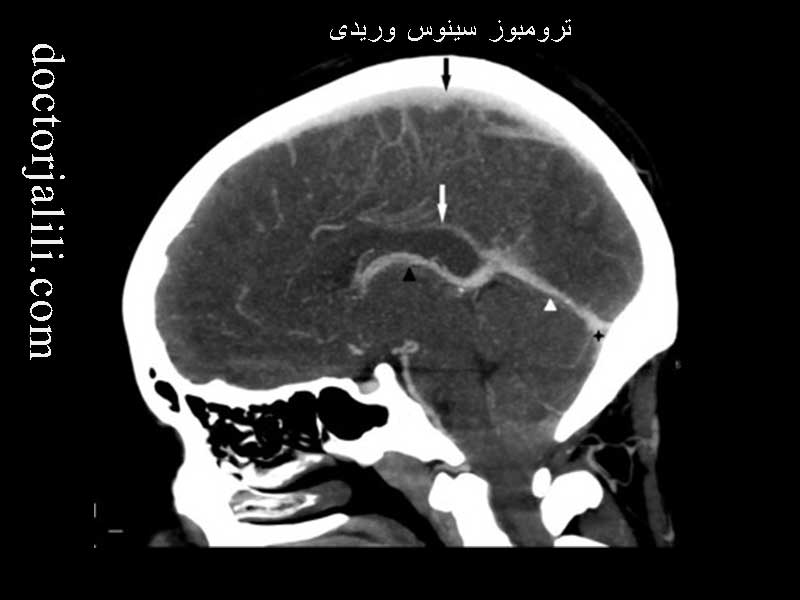 ترومبوز سینوس وریدی مغز؛علائم تا درمان
